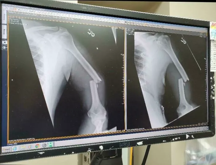 My (Nearly 60 Y/O) Fathers Arm After Being Thwomped By A Cow This Morning