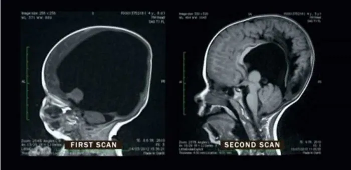 Mri Scans Of A Boy Born With Only 2% Of His Brain And 2 Years Later. His Brain Regrew To 80% Of Its Intended Size And He Only Suffers From Comparably Small Cognitive Deficits Today