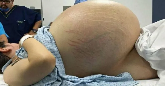 33kg Ovarian Cyst - Full Case