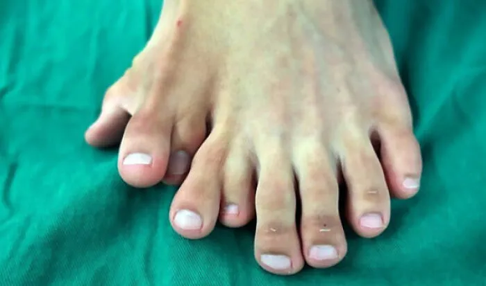 Polidactilia