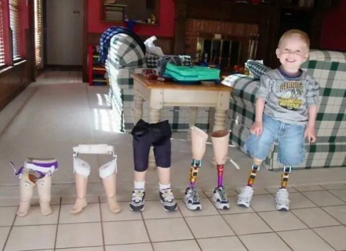 While An Adult May Be Able To Use One Prosthetic For A Decade, A Child Will Likely Require Several Prosthetics In That Same Time Period