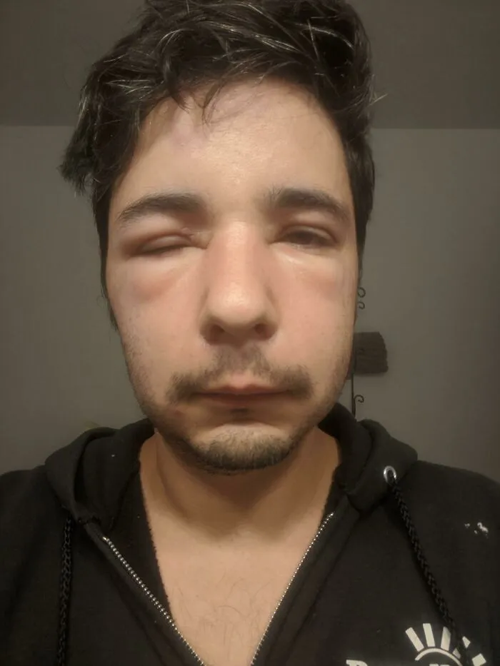 Me picaron dos veces, una vez en la frente y la otra en la punta de la oreja