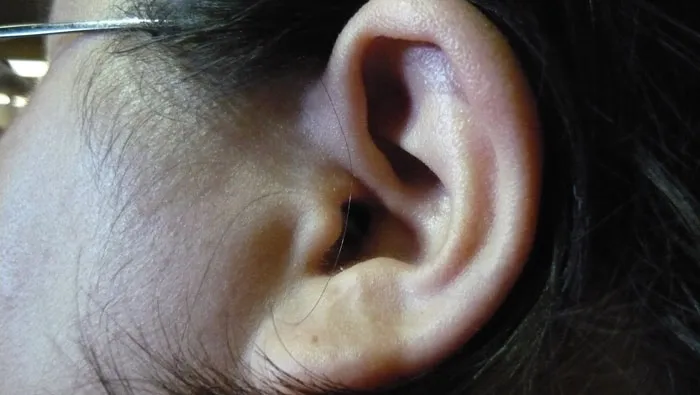 Tinnitus