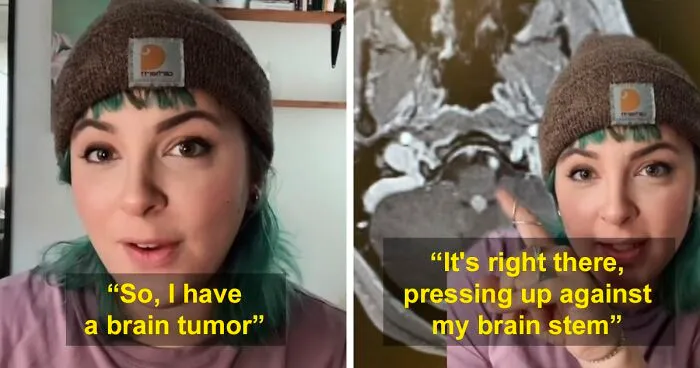 Woman With Brain Tumor Scared And Heartbroken Over The Fact She Can't Get It Removed Because Of Unvaccinated People