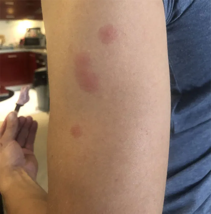 I Brought Bed Bugs Home From Airbnb Stay
