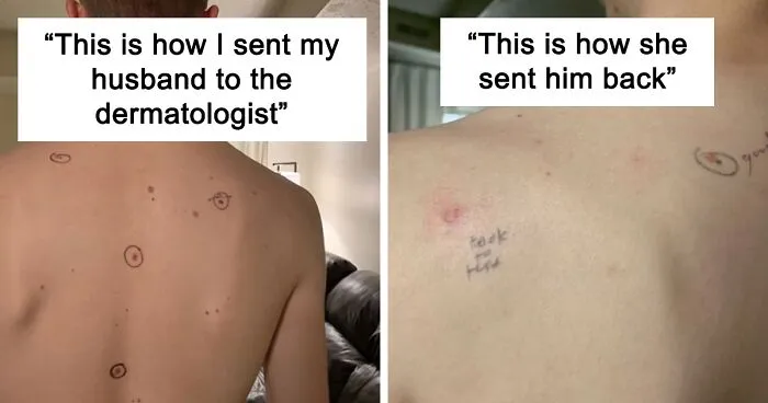 Wife Circled Her Husband's Moles Before He Went To The Doctor, He Came Back With Notes On His Body