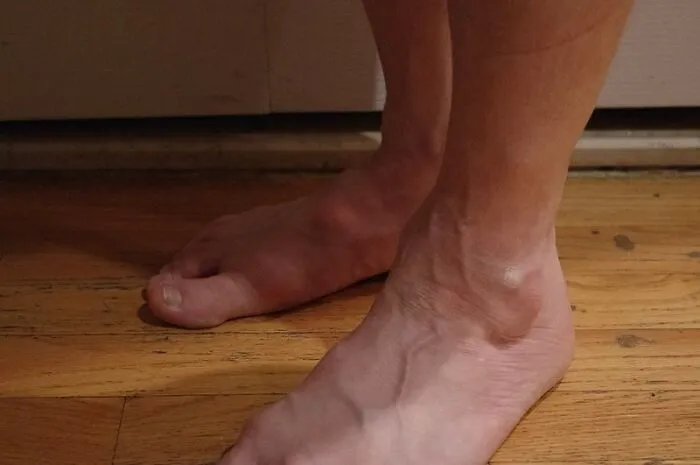 Bultos en los pies