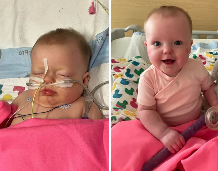 Before And After: My Daughter Battling A Combination Of RSV, Rhino Enterovirus, And Bacterial Pneumonia. She Almost Died, But She’s Now Home Safe And Sound