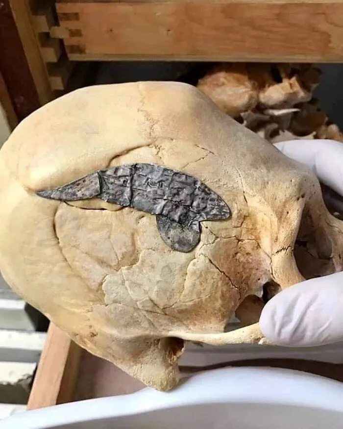 A Peruvian Elongated Skull With A Metal Plate Surgically Implanted, Estimated To Be From About 2000 Years Ago. The Broken Bone Surrounding The Repair Is Tightly Fused Together Indicating It Was A Successful Surgery