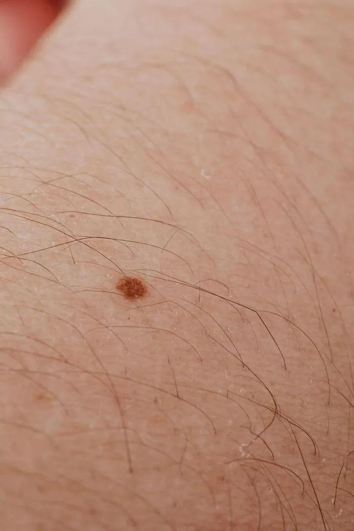 Close-up of skin with a mole emphasizing basic and genius safety tips everyone should know for health awareness.