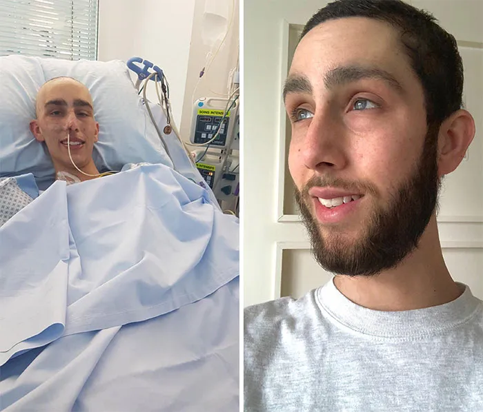 Pasé por la quimioterapia, decidí vencer al cáncer e intenté dejarme crecer la barba por primera vez. Nunca volví la vista atrás