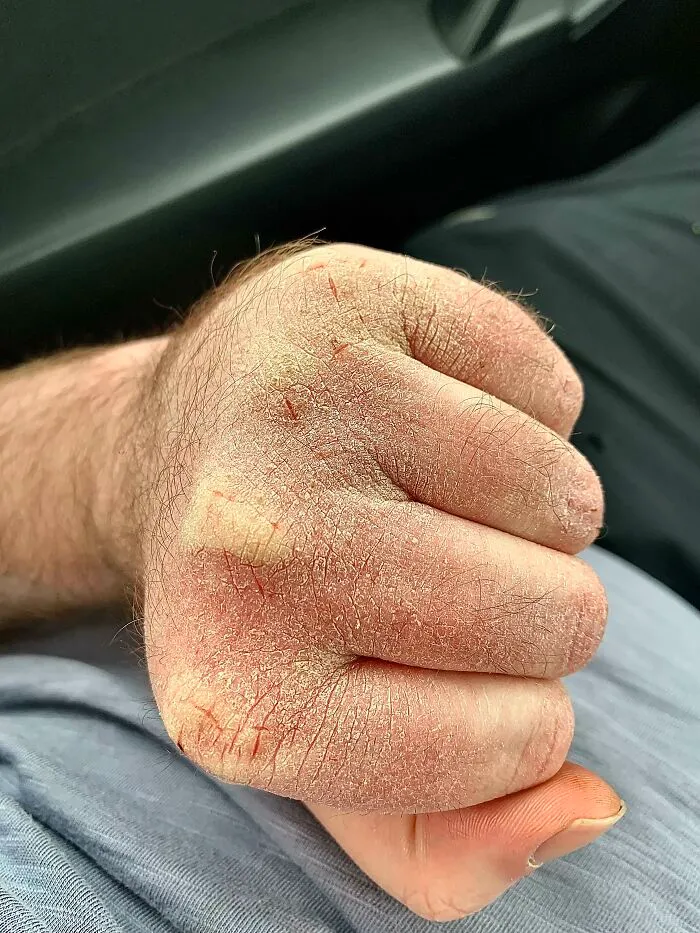Consecuencias de trabajar en un laboratorio a -10°C donde tengo que lavarme las manos 40 veces al día