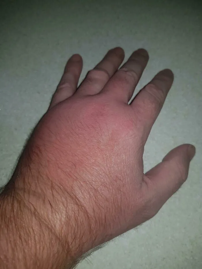 Moved To Australia And Was Warned About The Snakes And Spiders. I Give You A Single Ant Bite