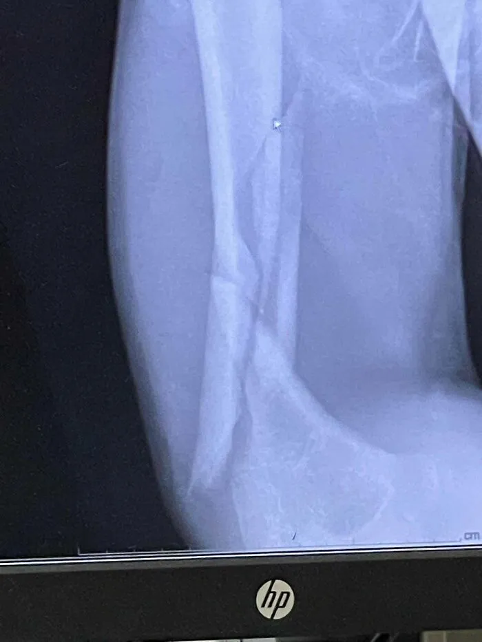 Broke And Dislocated My Arm. Happy Birthday To Me