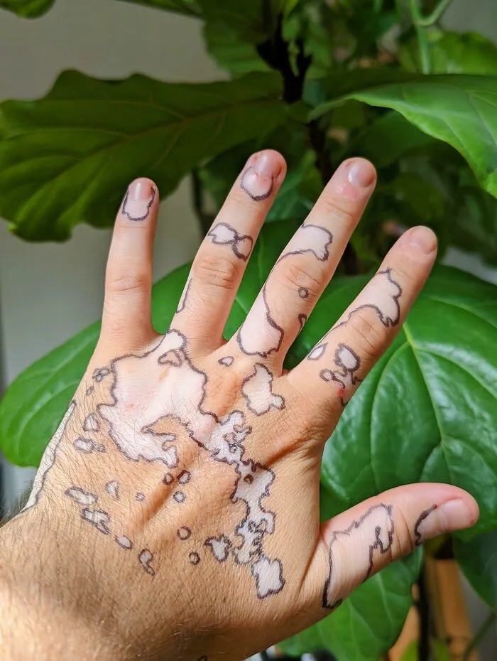 Tracé alrededor de mis manchas de vitíligo