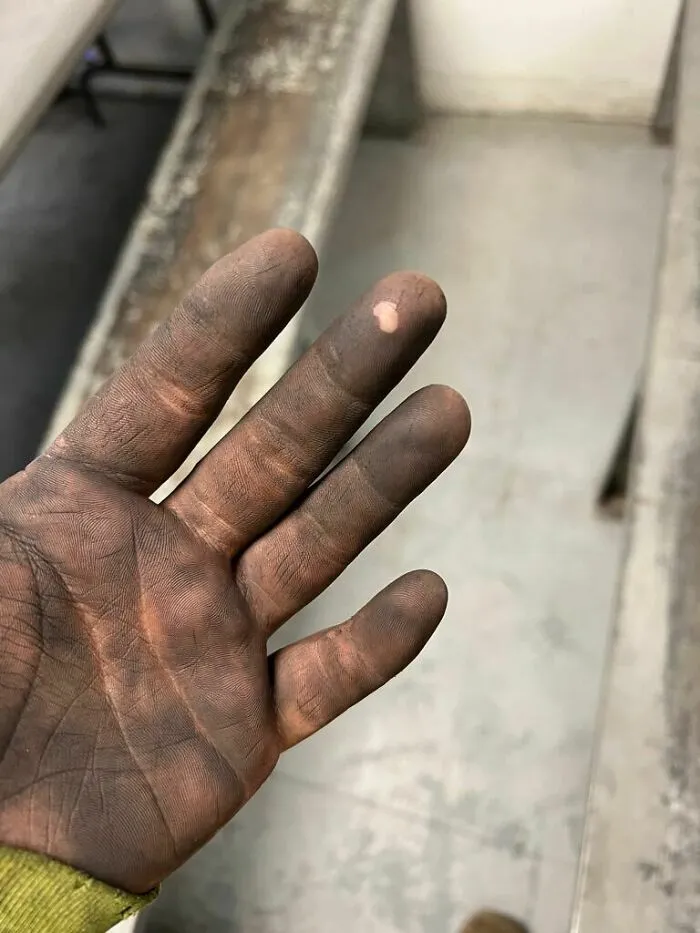 This Burn On My Finger Doesn’t Get Dirty