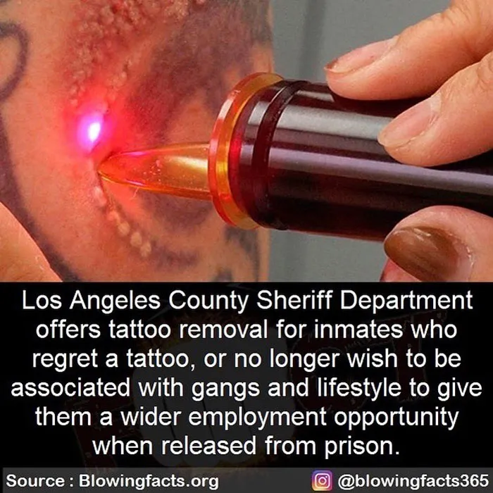 Tattoo Removal