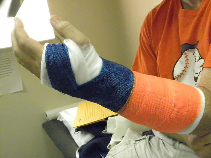 A Cast On A Broken Arm