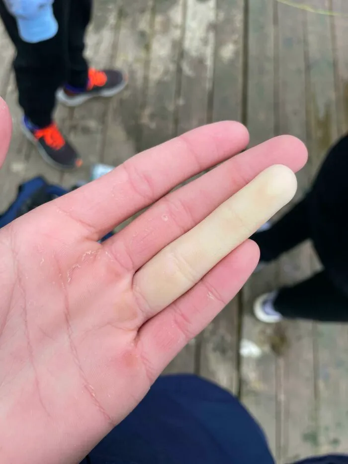 Se me ha vuelto el dedo blanco tras estar remando con mucho frío