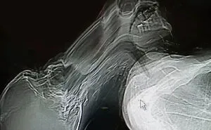 40 Bizarre And Inspiring Medical Cases That People Shared On This Online Community (New Pics)