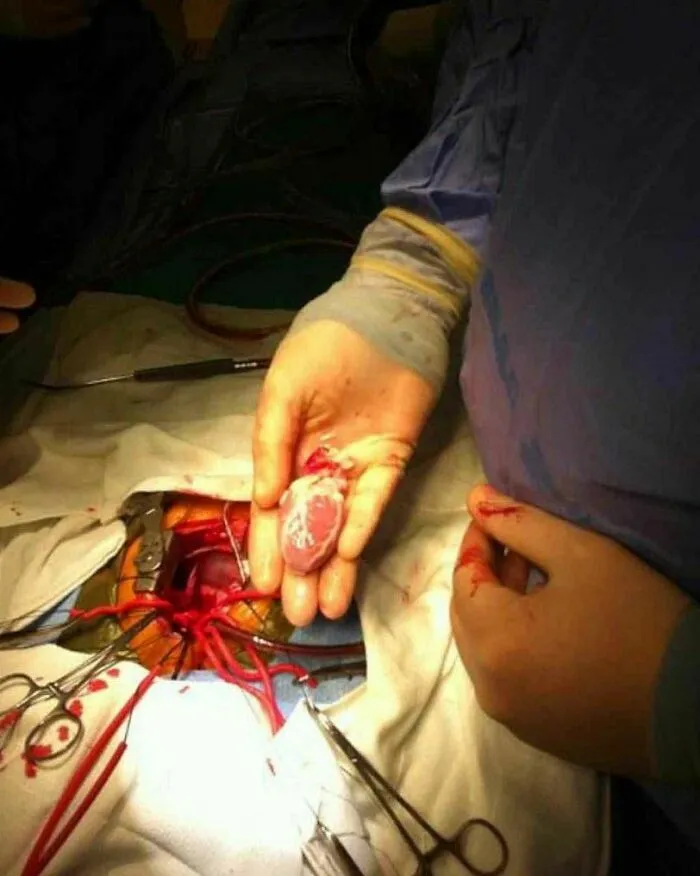 Transplante de corazón pediátrico