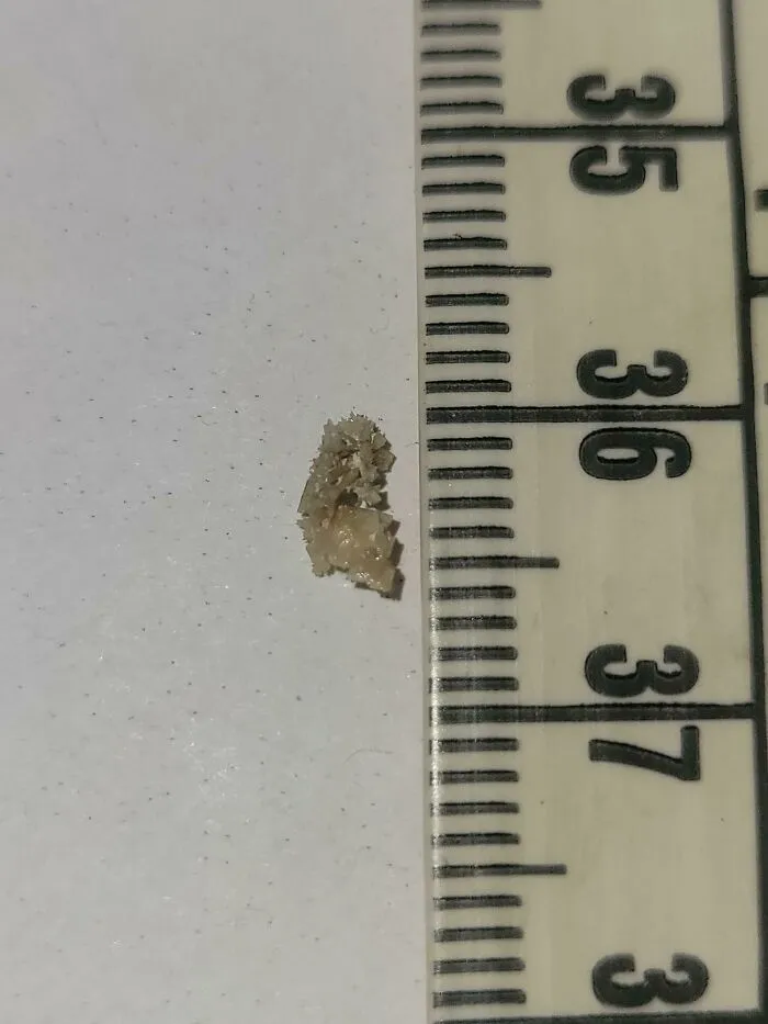 My Husband Suffers Frequent Kidney Stones. He Just Passed This Nightmarish Thing