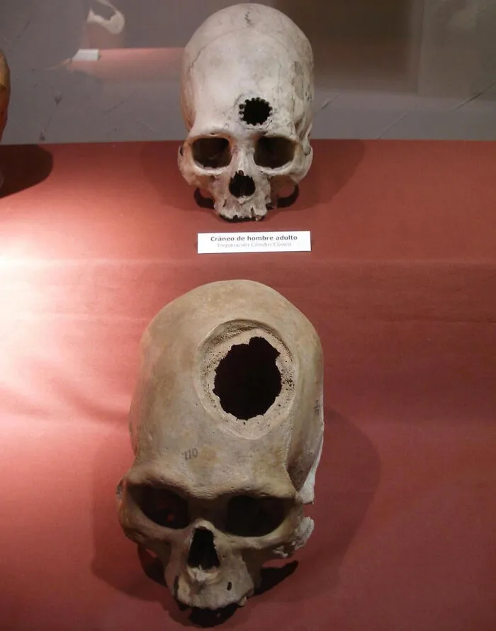 Archeological Remains Of Patients Of Brain Surgery Performed By Ancient Doctors Of The Inca Empire In The 15th Century