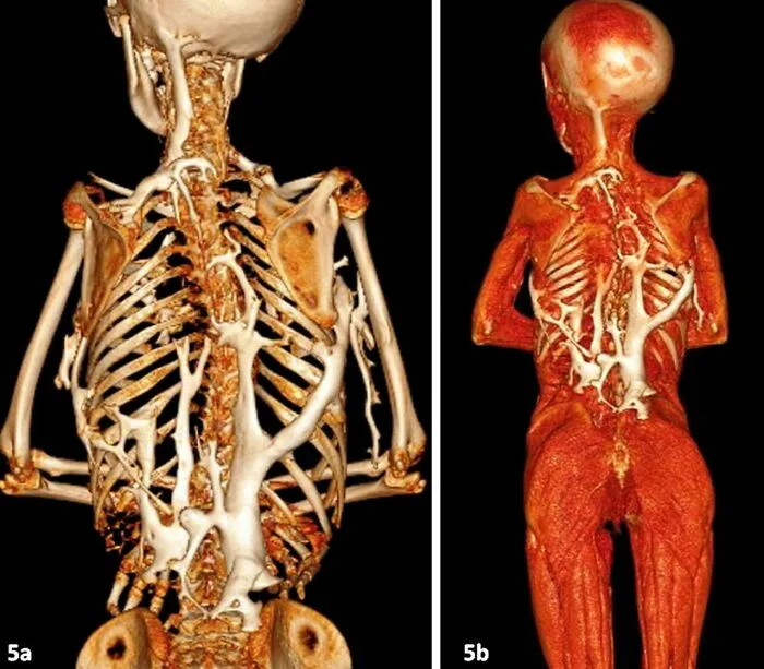 La enfermedad del hombre de piedra: fibrodisplasia osificante progresiva