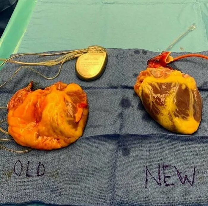 Heart Transplant! Bad Heart Going Out And A New Heart Going In!