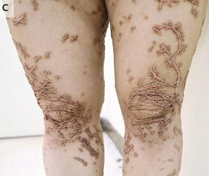 Extreme Case Of Eruptive Xanthoma
