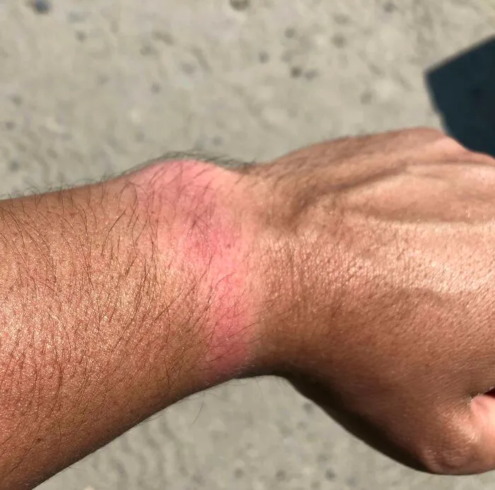 No llevé el reloj a la playa y me quemé con el sol