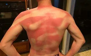 “I Don’t Need Sunscreen”: 50 People Who Thought So And Ended Up Looking Like Dorks (New Pics)