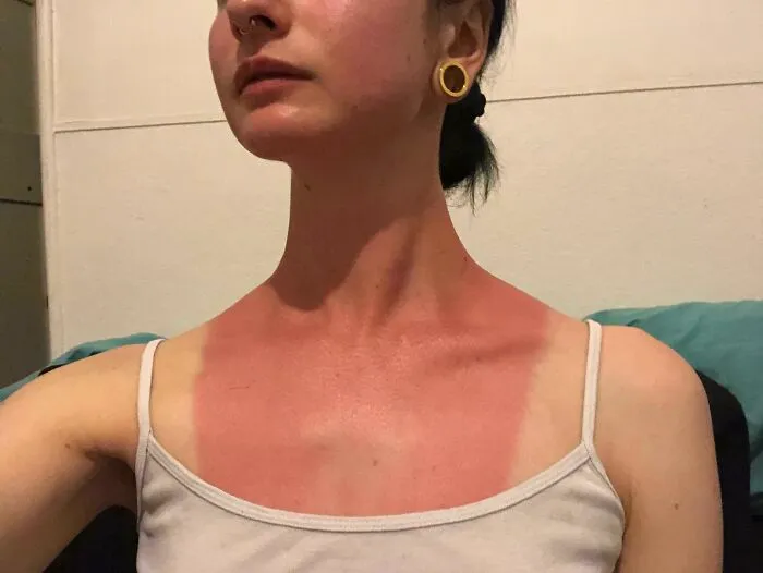 Hoy salí en un barco sin protector solar y ahora tengo lo que estoy llamando "el peto del dolor"