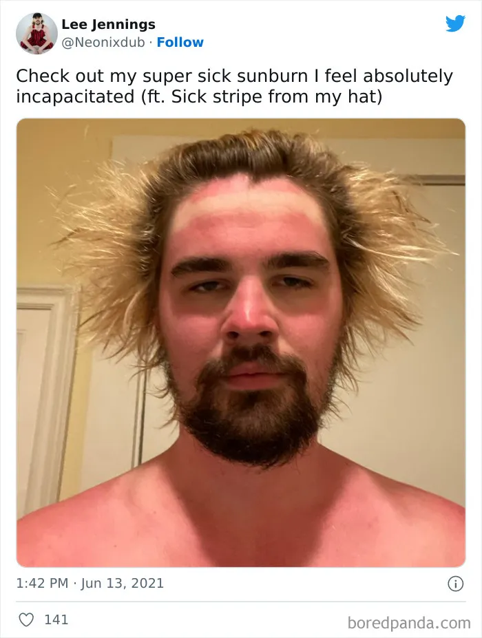 Very Sunburned