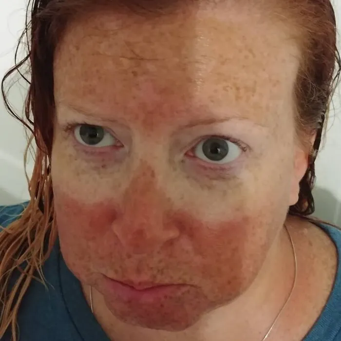 When You Forget To Put Sunscreen On Your Face But At Least Your Sunglasses Work