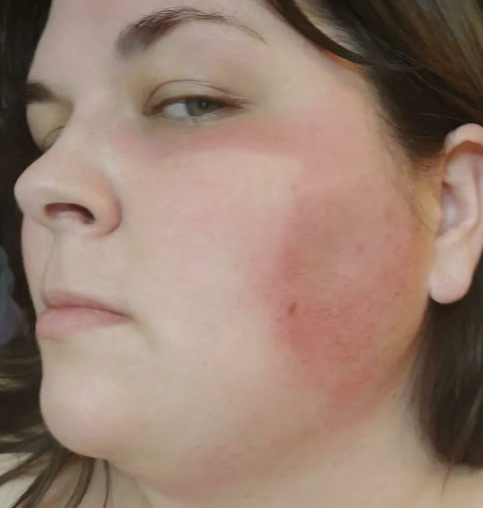 Trabajando en una clínica de vacunas al aire libre. No pensé en la protección solar... Ahora tengo una quemadura solar en forma de mascarilla, pero solo en la mitad de la cara