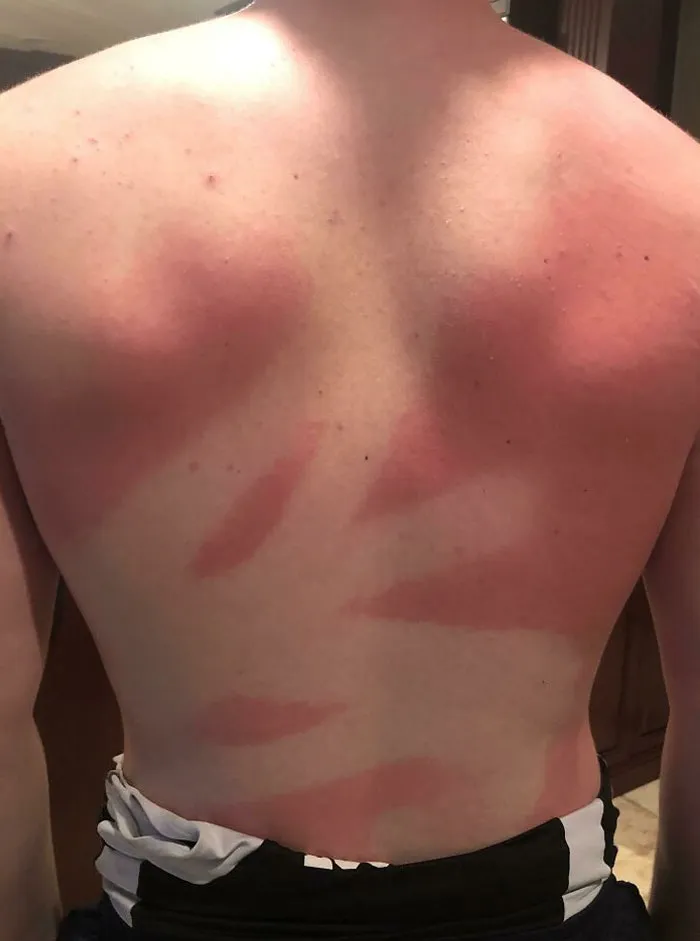 Asked My Friend To Spray Sunscreen On My Back... Not The Most Even Coat