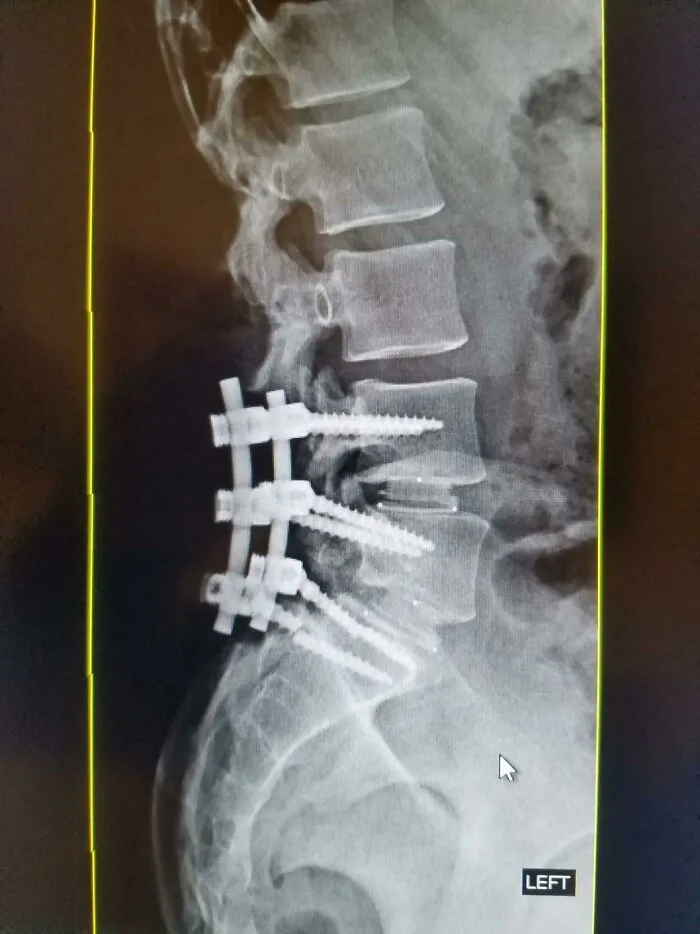 Esa vez que se me rompió uno de los tornillos en mi espalda