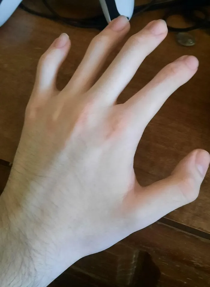 None Of My Fingers (Or Toes) Have Middle Knuckles, And It's Hereditary