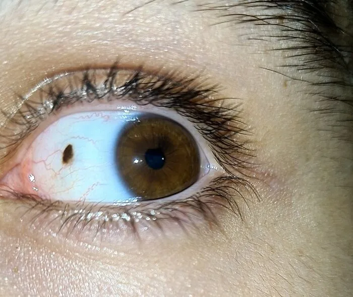 I Have A Freckle On My Eye