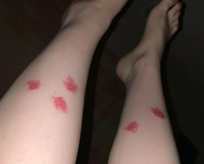 I Have Skeeter Syndrome (Allergic To Mosquito Salvia)