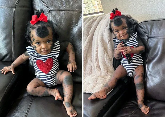 Congenital Melanocytic Nevus Is Visible Pigmented Spots On The Skin Present At Birth. They Usually Are Brown, Tan, Pink, Or Black. Some Moles Produce Dark, Coarse Hair