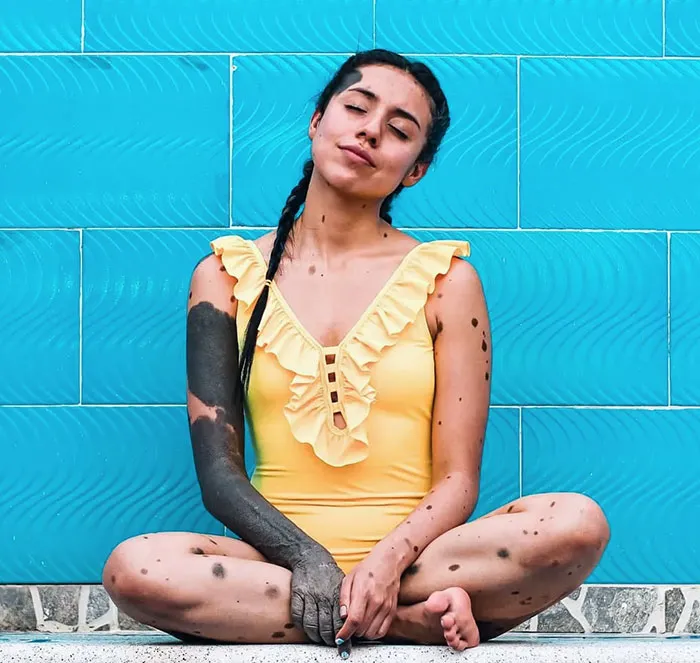 Nevus melanocítico congénito. Aparece como una mancha circunscrita, de color marrón claro a negro, que cubre una superficie de cualquier tamaño y cualquier parte del cuerpo 