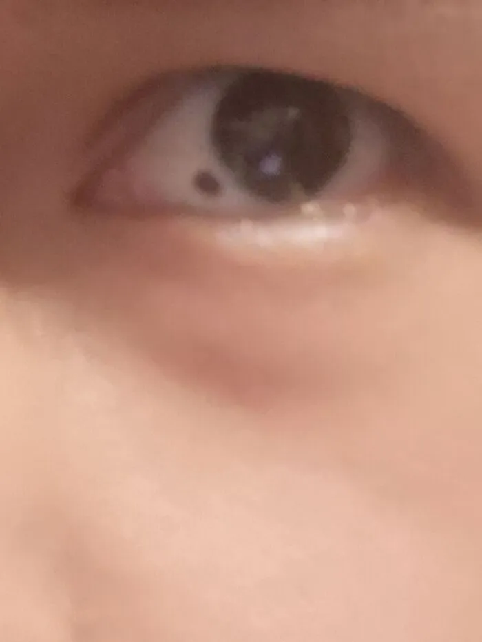 I Have An Eye Mole!
