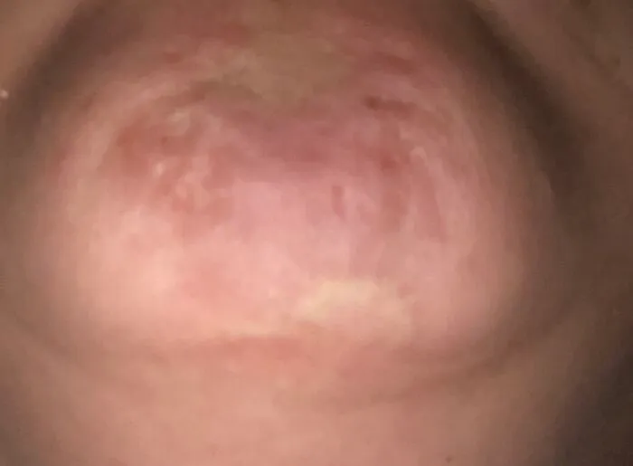 My Chin. Fell On Side Of Bathtub At 3. Tripped On Sidewalk At 6. Bike Wreck At 12