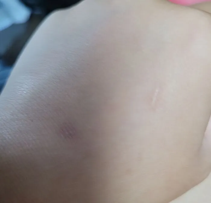 The Bottom One Is When I Tore Open A Mosquito Bite That Was Bugging Be, And The Top Was Made With A Pencil. Only It Was A Dull Pencil That I Rubbed Against My Hand