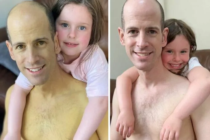 Man Shares Pictures Before And After A Liver Transplant