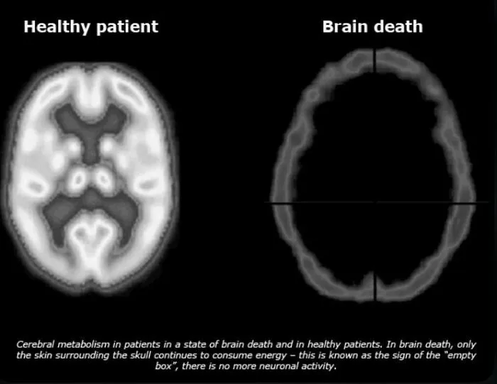 The “Empty Box” Void Of A Brain Death