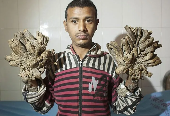 Epidermodysplasia Verruciformis "Treeman Syndrome"