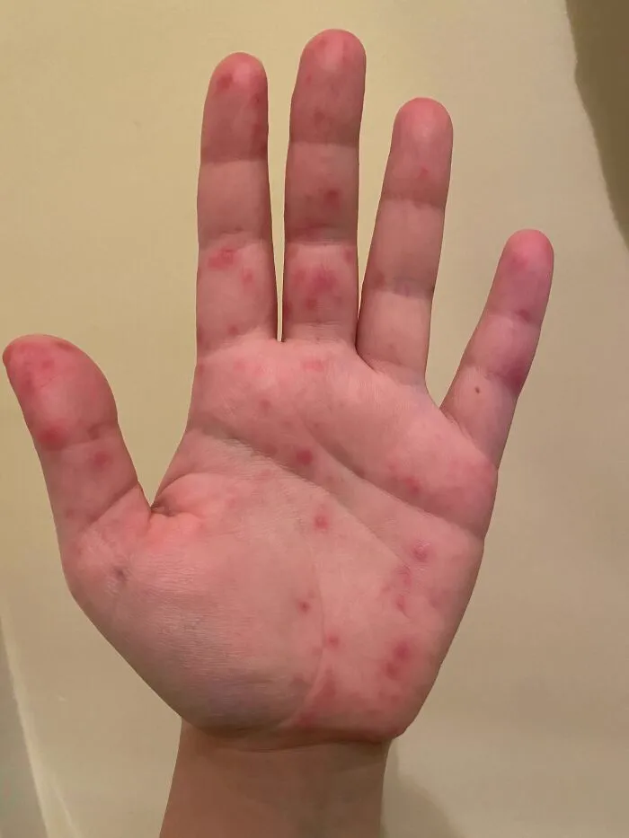 Anddd Just Like That Thanksgiving Is Cancelled… Hand Foot Mouth Disease